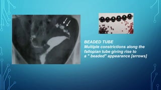 BEADED TUBE
Multiple constrictions along the
fallopian tube giving rise to
a " beaded" appearance [arrows]
 