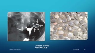 SAMPLE FOOTER TEXT 10/3/2018 43
COBBLE STONE
APPEARANCE
 