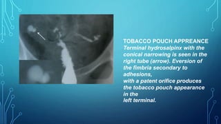 TOBACCO POUCH APPREANCE
Terminal hydrosalpinx with the
conical narrowing is seen in the
right tube (arrow). Eversion of
the fimbria secondary to
adhesions,
with a patent orifice produces
the tobacco pouch appearance
in the
left terminal.
 