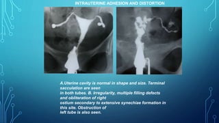 INTRAUTERINE ADHESION AND DISTORTION
A.Uterine cavity is normal in shape and size. Terminal
sacculation are seen
in both tubes. B. Irregularity, multiple filling defects
and obliteration of right
ostium secondary to extensive synechiae formation in
this site. Obstruction of
left tube is also seen.
 