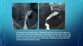 A. Pseudo-unicornuate uterus. Unilateral scarring of the cavity makes an
asymmetric intrauterine obliteration, resembling a unicornuate uterus. the
irregular contour and vertical orientation of long axis. B. True unicornuate
uterus. the smooth contour, more horizontal orientation of long axis and
normal ipsilateral fallopian tube.
 