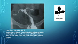 TRIFOLIATE SHAPED UTERUS
Synechiae formation at the uterine borders and partial
obliteration in the fundus produce a trifoliate like
appearance. Both tubes are obstructed in the isthmic
portion
 