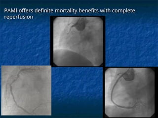 Pharmaco-Invasive Therapy in Acute Myocardial Infarction Management ...