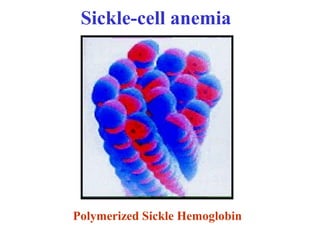 Polymerized Sickle Hemoglobin
Sickle-cell anemia
 