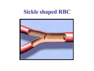 Sickle shaped RBC
 