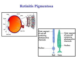 Retinitis Pigmentosa
 