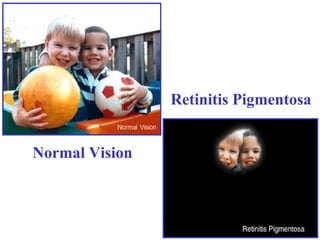 Normal Vision
Retinitis Pigmentosa
 