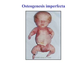 Osteogenesis imperfecta
 