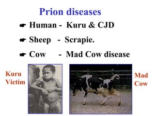 Prion diseases
 Human - Kuru & CJD
 Sheep - Scrapie.
 Cow - Mad Cow disease
Kuru
Victim
Mad
Cow
 