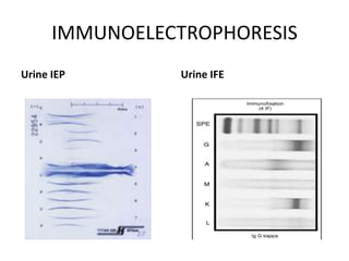 IMMUNOELECTROPHORESISUrine IEPUrine IFE