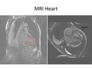 MRI Heartseptum
