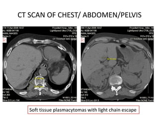 CT Scan of Abdomen and PelvisCT SCAN OF CHEST/ ABDOMEN/PELVISSoft tissue plasmacytomas with light chain escape