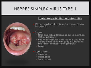 HERPES SIMPLEX VIRUS TYPE 1

           Acute Herpetic Pharyngotonsilitis

         Pharyngotonsilitis is seen more often
          in adults

         Signs
           Oral and labial lesions occur in less than
            10% of patients
           Ruptured vesicles may rupture and form
            ulcerative lesions with gray exudates n
            the tonsils and posterior pharynx
           Fever

         Symptoms
           Malaise
           Headache
           Sore throat
 