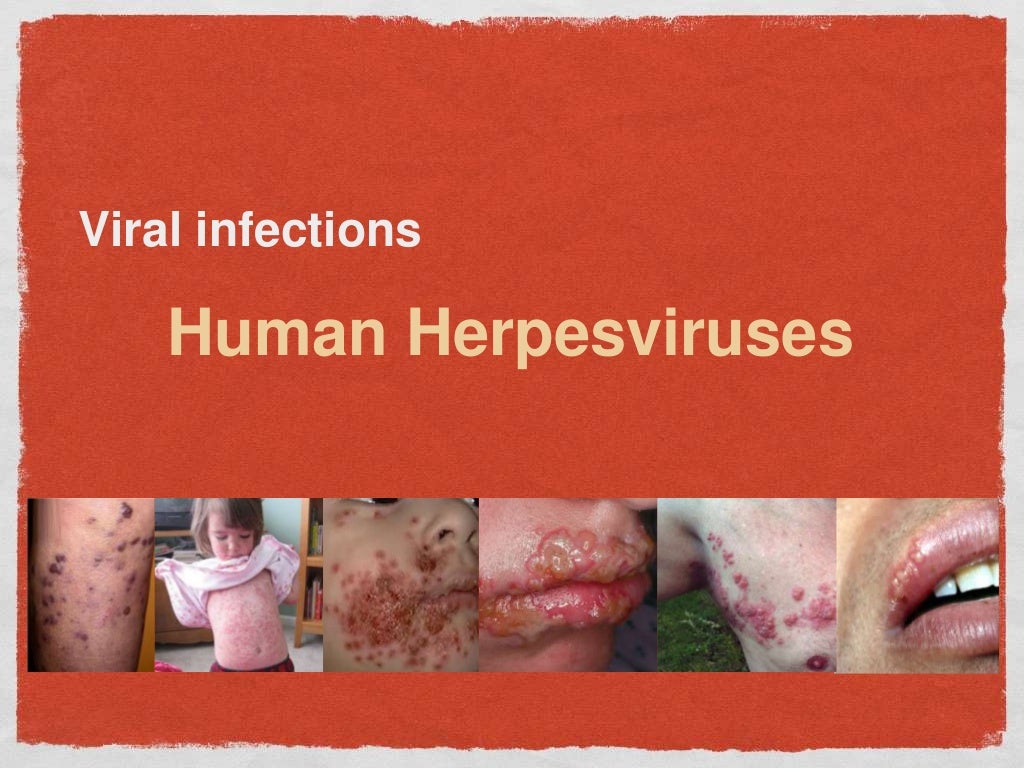 Hsv 1 Pictures : Frontiers Herpes Simplex Virus Type 1 Infection Of The Central Nervous System ...