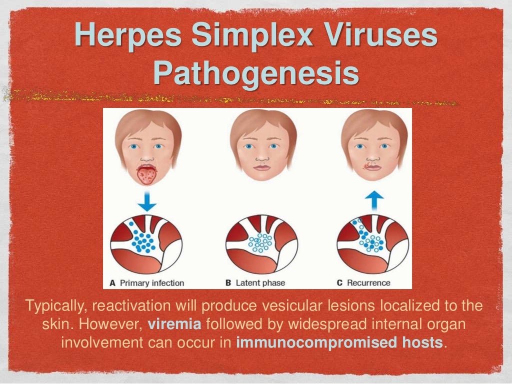 Characteristics of herpes simplex virus infection and pathogenesis suggest a strategy for ...