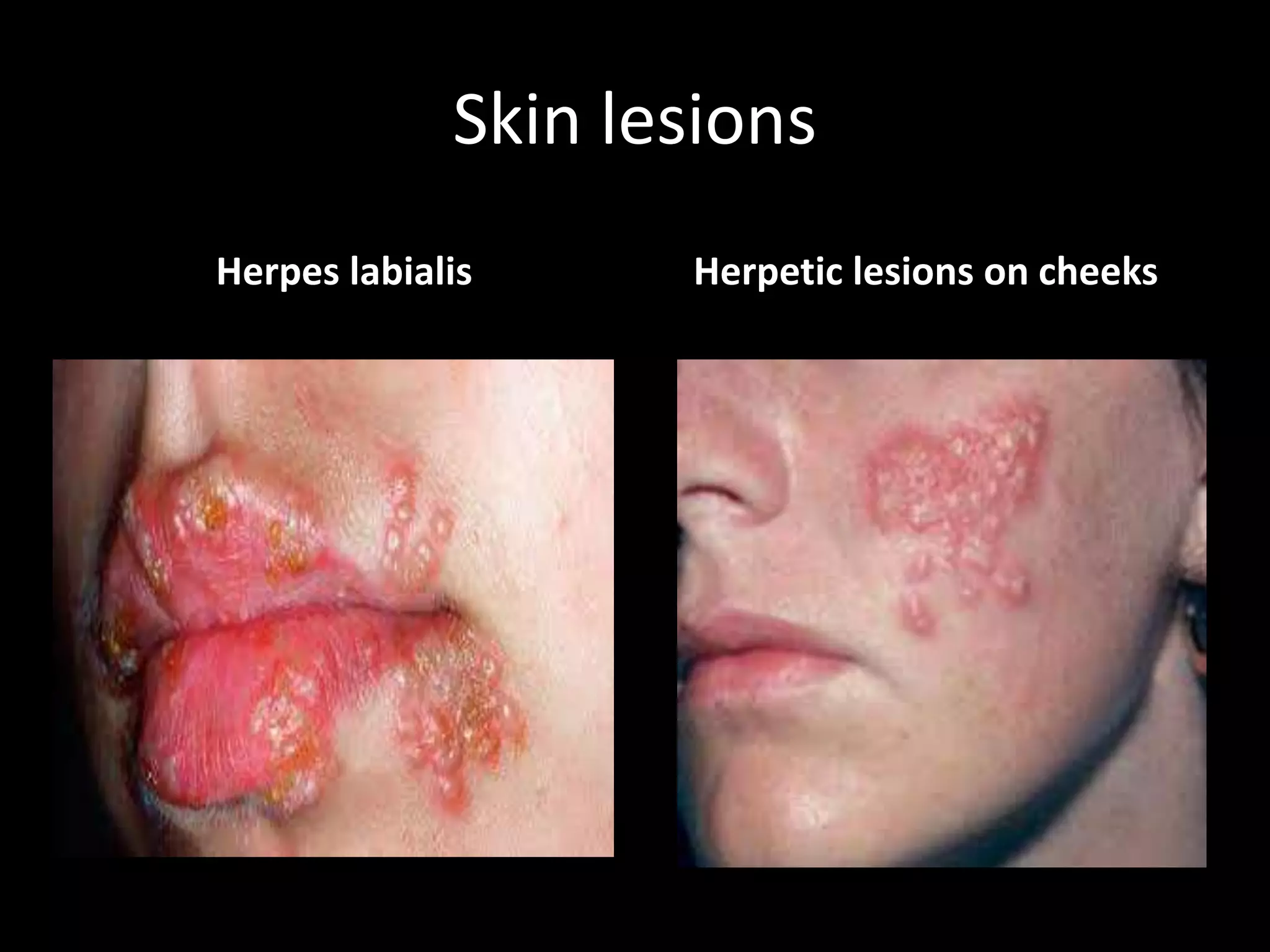 Herpes Simplex Virus (HSV) and Varicella Zoster Virus (VZV) by Dr
