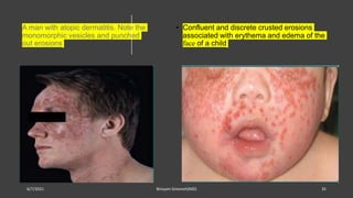 Hsv Diffuse Rash Hsv infections(cutaneous and genital) | PPTX