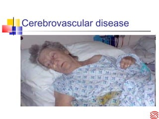 Cerebrovascular disease
 