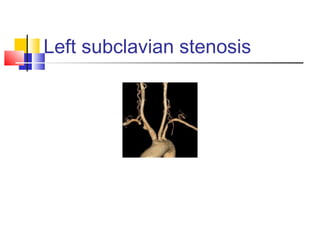 Left subclavian stenosis
 
