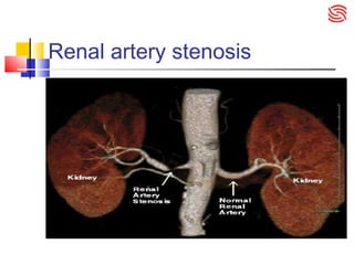 Renal artery stenosis
 