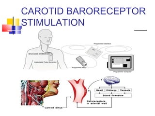 CAROTID BARORECEPTOR
STIMULATION
 