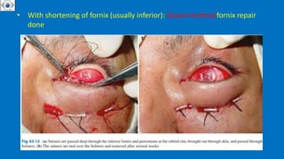 • With shortening of fornix (usually inferior): Closed method fornix repair
done
 