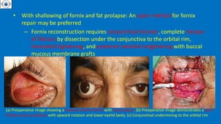 • With shallowing of fornix and fat prolapse: An open method for fornix
repair may be preferred
– Fornix reconstruction requires conjunctival incision, complete release
of fibrosis by dissection under the conjunctiva to the orbital rim,
horizontal tightening, and posterior lamellar lengthening with buccal
mucous membrane grafts
(a) Preoperative image showing a shelved inferior fornix with fat prolapse. (b) Preoperative image demonstrates a poor
fitting ocular prosthesis with upward rotation and lower eyelid laxity. (c) Conjunctival undermining to the orbital rim
 