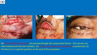 • .
(d)Fornix-deepening sutures are passed through the conjunctival fornix . The sutures are
externalized and tied over bolsters. (e) Lateral canthal tendon tightening is performed. (f)
Prosthesis is in optimal position at the end of the procedure
 