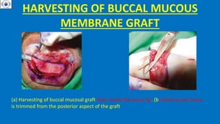 HARVESTING OF BUCCAL MUCOUS
MEMBRANE GRAFT
(a) Harvesting of buccal mucosal graft from inside the lower lip. (b) Submucosal tissue
is trimmed from the posterior aspect of the graft
 