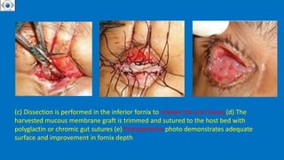 • .
(c) Dissection is performed in the inferior fornix to release the scar tissue.(d) The
harvested mucous membrane graft is trimmed and sutured to the host bed with
polyglactin or chromic gut sutures (e) Postoperative photo demonstrates adequate
surface and improvement in fornix depth
 
