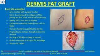 DERMIS FAT GRAFT
• Donor site preparation
– Area marked with surgical marker
– Site is 5 cm below the mid point of line
joining ant iliac spine and ischial tuberosity
– Ideally 20-25 mm area is marked
– Epidermis is carefully shaved with a 15 no
blade
– Incision should be superficial to dermis
– Perpendicular incision through the dermis
is made
– Fat plug of 20-30 mm deep is excised
– Graft is oversized to account for shrinkage
– Donor site closed
(a) A 25 mm diameter circle is marked on the skin of the gluteal region(b) Epidermis is incised superficially until minute
pinpoint bleeding is visible. (c) The harvested dermis fat graft is 20–30 mm in depth.
 