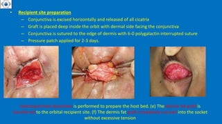 • Recipient site preparation
– Conjunctiva is excised horizontally and released of all cicatrix
– Graft is placed deep inside the orbit with dermal side facing the conjunctiva
– Conjunctiva is sutured to the edge of dermis with 6-0 polygalactin interrupted suture
– Pressure patch applied for 2-3 days.
Subconjunctival dissection is performed to prepare the host bed. (e) The dermis fat graft is
transferred to the orbital recipient site. (f) The dermis fat graft completely sutured into the socket
without excessive tension
 