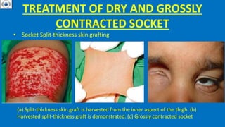 TREATMENT OF DRY AND GROSSLY
CONTRACTED SOCKET
• Socket Split-thickness skin grafting
(a) Split-thickness skin graft is harvested from the inner aspect of the thigh. (b)
Harvested split-thickness graft is demonstrated. (c) Grossly contracted socket
 