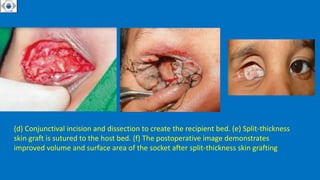 • .
(d) Conjunctival incision and dissection to create the recipient bed. (e) Split-thickness
skin graft is sutured to the host bed. (f) The postoperative image demonstrates
improved volume and surface area of the socket after split-thickness skin grafting
 