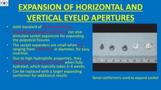 EXPANSION OF HORIZONTAL AND
VERTICAL EYELID APERTURES
• Gold standard of serial conformers
• Expanding hydrogel conformers can also
stimulate socket expansion for expanding
the palpebral fissures
• The socket expanders are small when dry,
ranging from 6 to 9 mm in diameter, for easy
insertion
• Due to high hydrophilic properties, they
expand to 11, 14, and 18 mm when fully
hydrated, which typically takes 2–4 weeks.
• Can be replaced with a larger expanding
conformer for additional results
Serial conformers used to expand socket
 