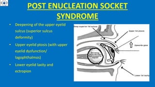 POST ENUCLEATION SOCKET
SYNDROME
• Deepening of the upper eyelid
sulcus (superior sulcus
deformity)
• Upper eyelid ptosis (with upper
eyelid dysfunction/
lagophthalmos)
• Lower eyelid laxity and
ectropion
 