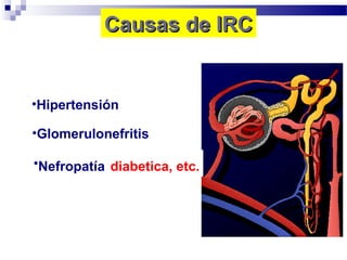 Causas de IRC


•Hipertensión

•Glomerulonefritis

•Nefropatía diabetica, etc.
 