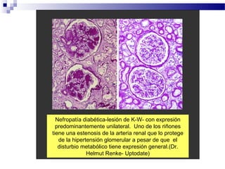 Nefropatía diabética-lesión de K-W- con expresión
  predominantemente unilateral. Uno de los riñones
tiene una estenosis de la arteria renal que lo protege
   de la hipertensión glomerular a pesar de que el
   disturbio metabólico tiene expresión general.(Dr.
               Helmut Renke- Uptodate)
 