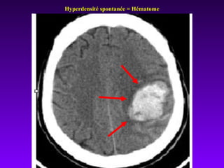 Hyperdensité spontanée = Hématome
 