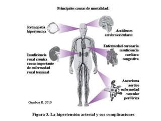 HIPERTENSIÓN ARTERIAL