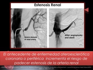 American Heart Association. Calhoun et al. Resistant Hypertension: Diagnosis, evaluation and treatment. Journal of American Heart Association.
2008: 51; 1403-1419. USA.
El antecedente de enfermedad ateroesclerótica
coronaria o periférica incrementa el riesgo de
padecer estenosis de la arteria renal
 