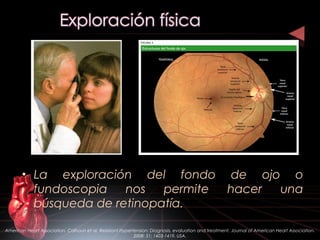 • La exploración del fondo de ojo o
fundoscopia nos permite hacer una
búsqueda de retinopatía.
American Heart Association. Calhoun et al. Resistant Hypertension: Diagnosis, evaluation and treatment. Journal of American Heart Association.
2008: 51; 1403-1419. USA.
 