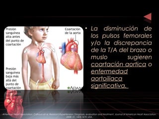 • La disminución de
los pulsos femorales
y/o la discrepancia
de la T/A del brazo o
muslo sugieren
coartación aortica o
enfermedad
aortoiliaca
significativa.
American Heart Association. Calhoun et al. Resistant Hypertension: Diagnosis, evaluation and treatment. Journal of American Heart Association.
2008: 51; 1403-1419. USA.
 