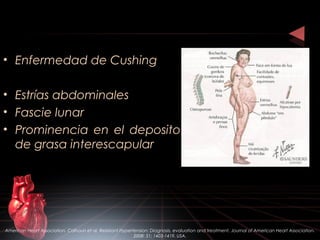 • Enfermedad de Cushing
• Estrías abdominales
• Fascie lunar
• Prominencia en el deposito
de grasa interescapular
American Heart Association. Calhoun et al. Resistant Hypertension: Diagnosis, evaluation and treatment. Journal of American Heart Association.
2008: 51; 1403-1419. USA.
 