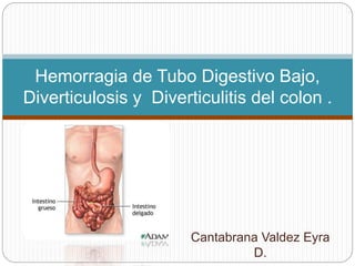 Cantabrana Valdez Eyra
D.
Hemorragia de Tubo Digestivo Bajo,
Diverticulosis y Diverticulitis del colon .
 