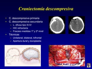 Craniectomía descompresiva
• C. descompresiva primaria
• C. descompresiva secundaria
– L. difusa tipo III-IV
– HIC refractaria
– Fracaso medidas 1º y 2º nivel
• Técnicas
– Unilateral, bilateral, bifrontal
– Apertura dural y duroplastia
 