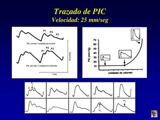 Trazado de PIC
Velocidad: 25 mm/seg
 