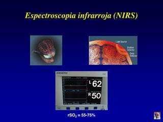 Espectroscopia infrarroja (NIRS)
rSO2 = 55-75%
 