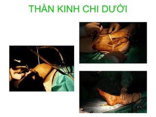 THẦN KINH CHI DƯỚI
 