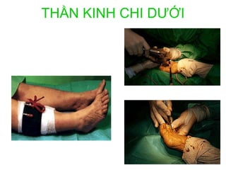 THẦN KINH CHI DƯỚI
 